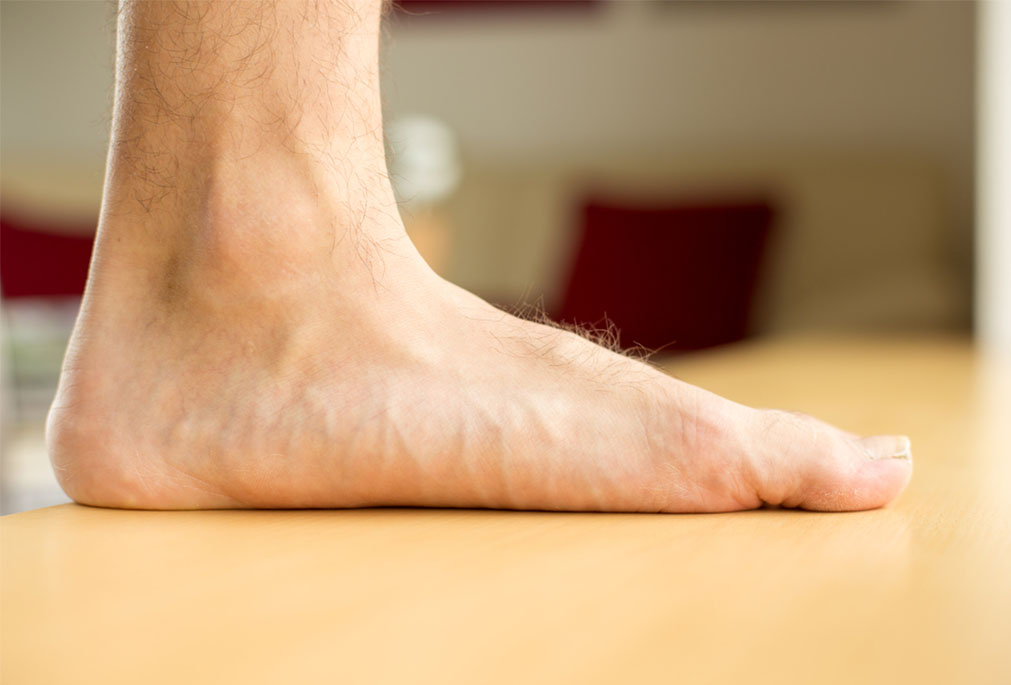 flat foot biomechanical changes in standing posture
